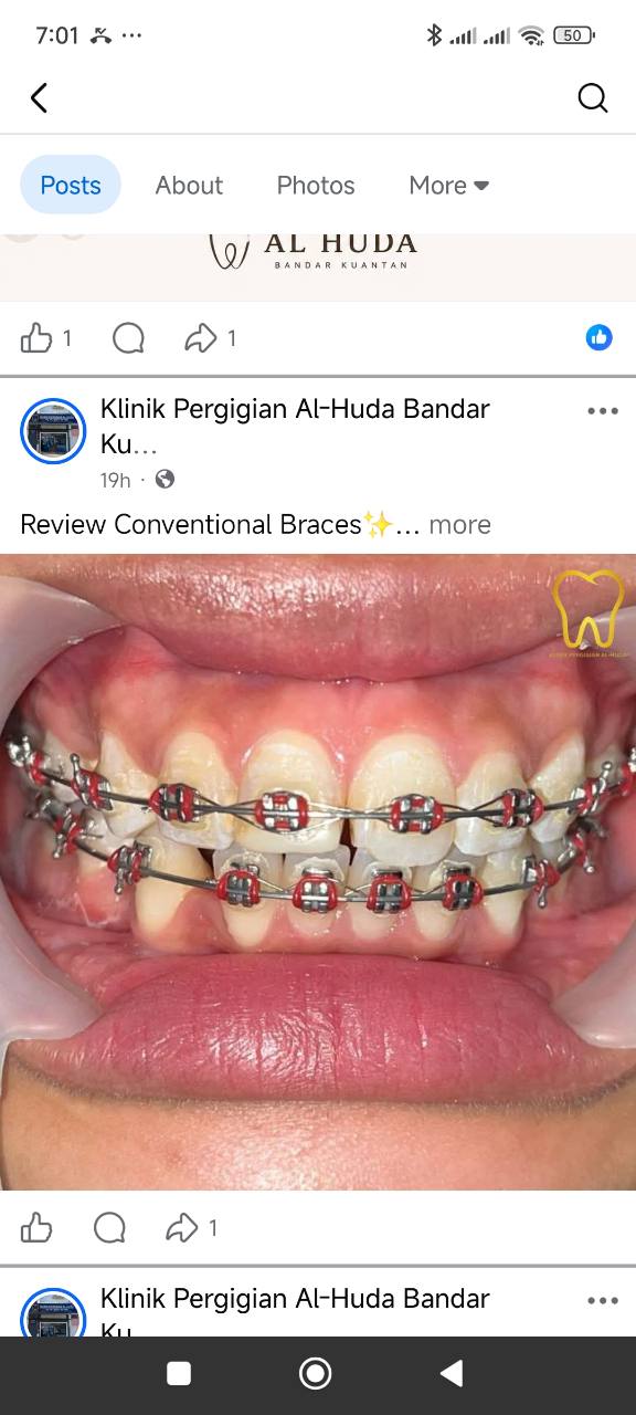 Rawatan braces konvensional